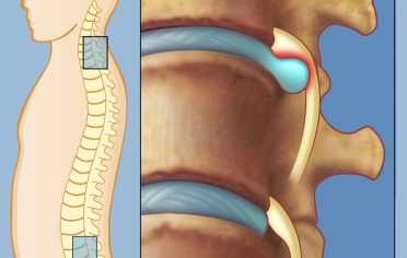 روش های درمان فتق دیسک 