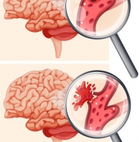 انواع سکته مغزی