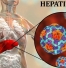 هپاتیت A چیست ؟