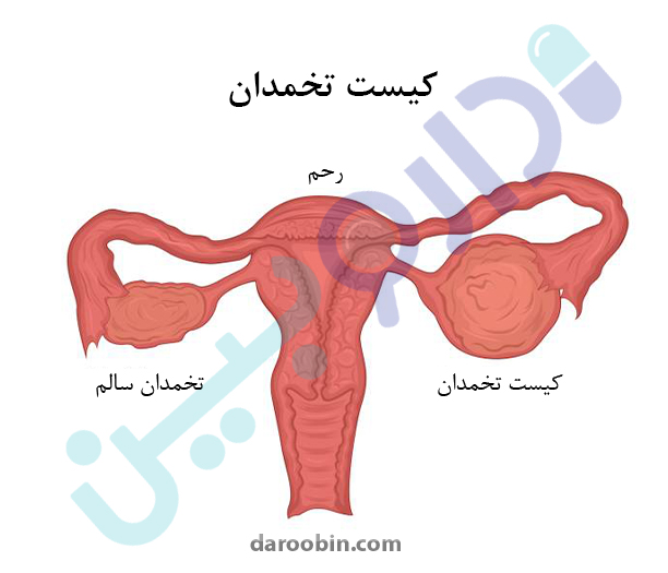 بیماری های تخمدان