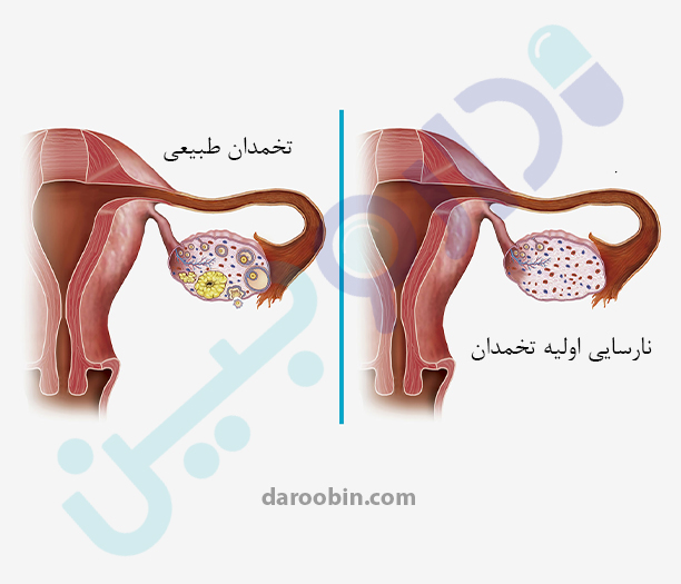 بیماری های تخمدان