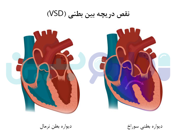 نقص دریچه بین بطنی (VSD)