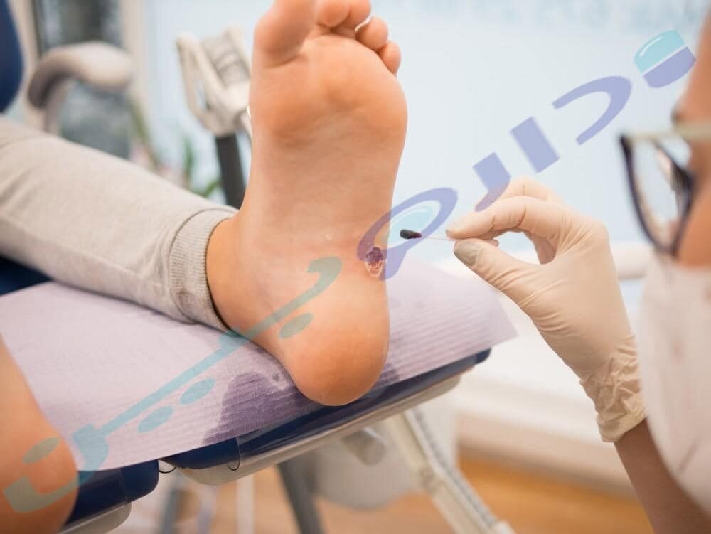 دکتر متخصص زگیل کف پا در حال درمان زگیل