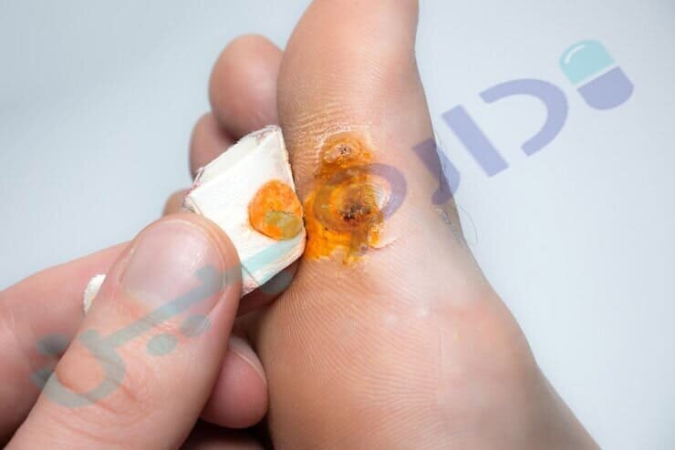 درمان زگیل پا با اسید سالیسیلیک