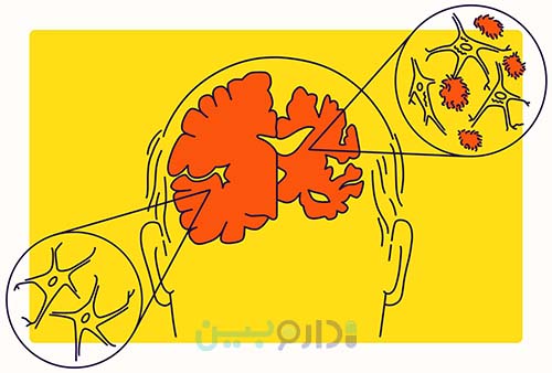 انواع آلزایمر