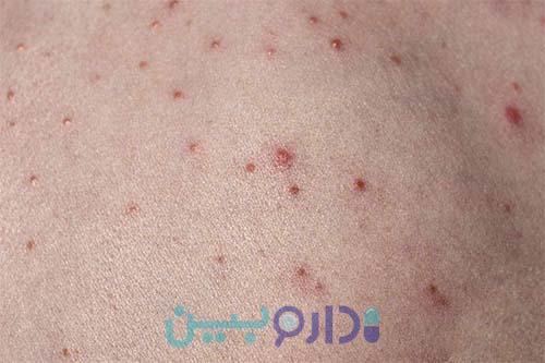 عفونت باکتریایی