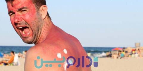 راه های جلوگیری از آفتاب سوختگی