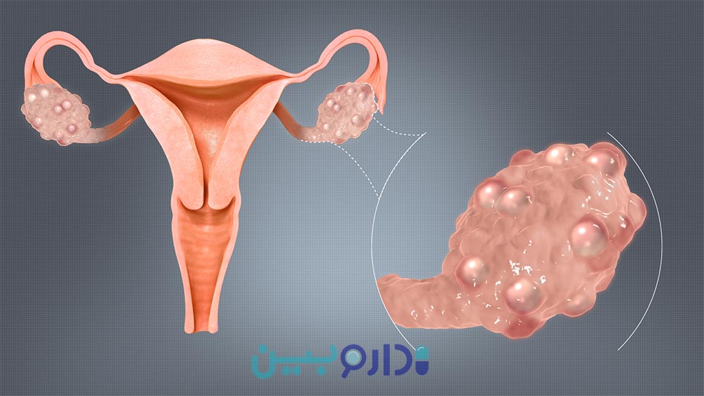 سندرم تخمدان پلی کیستیک